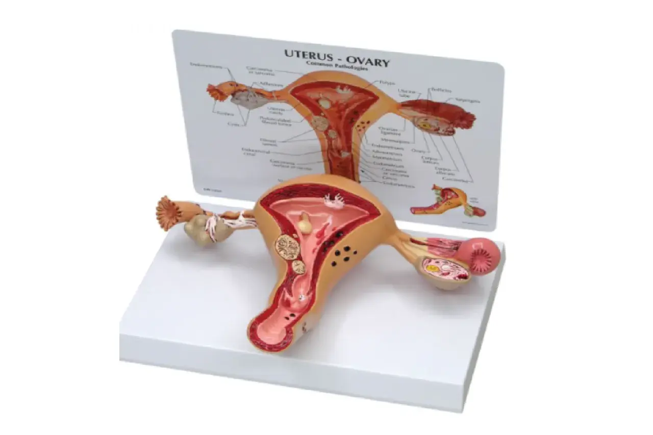 Model anatomiczny narządu rodnego kobiety z widocznymi jajnikami, macicą i jajowodami. Na tablicy informacyjnej zaznaczono patologie.