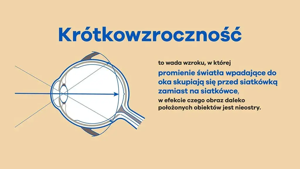 Krótkowzroczność: Objawy, przyczyny i skuteczne metody korekcji