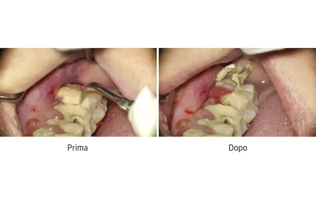 Prima e dopo la rimozione di un **tartaro grave**. La gengiva è infiammata e i denti sono coperti da depositi giallastri.