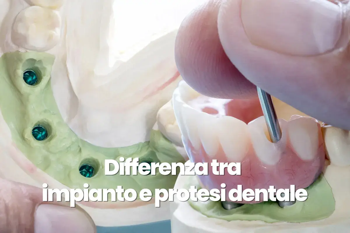 Modello dentale con impianti e una protesi dentale in fase di lavorazione.
