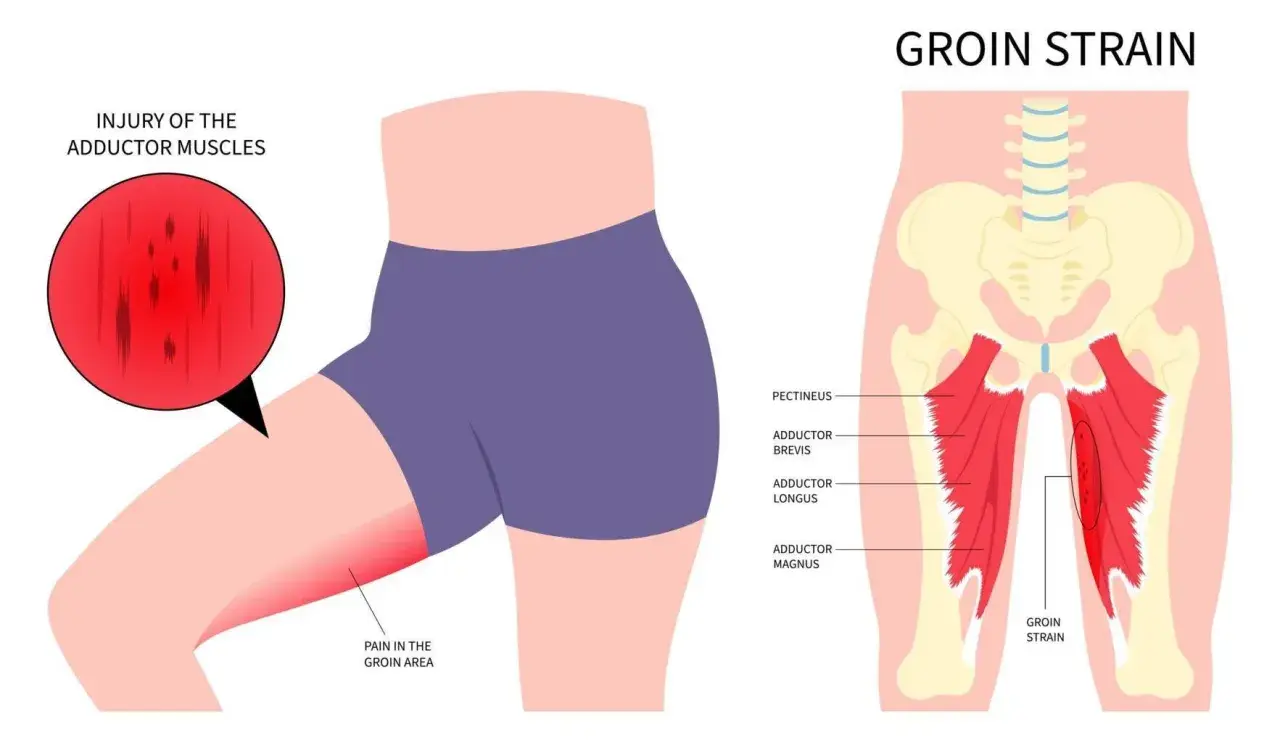 Illustration zeigt eine Zerrung der Adduktorenmuskeln im Leistenbereich. Wo ist die Leiste? Hier, rot markiert, mit Schmerz im Leistenbereich.