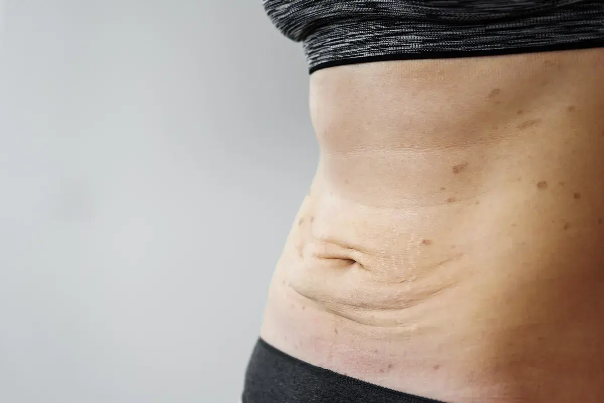 Luźna skóra po schudnięciu 20 kg, widoczne rozstępy i przebarwienia na brzuchu.