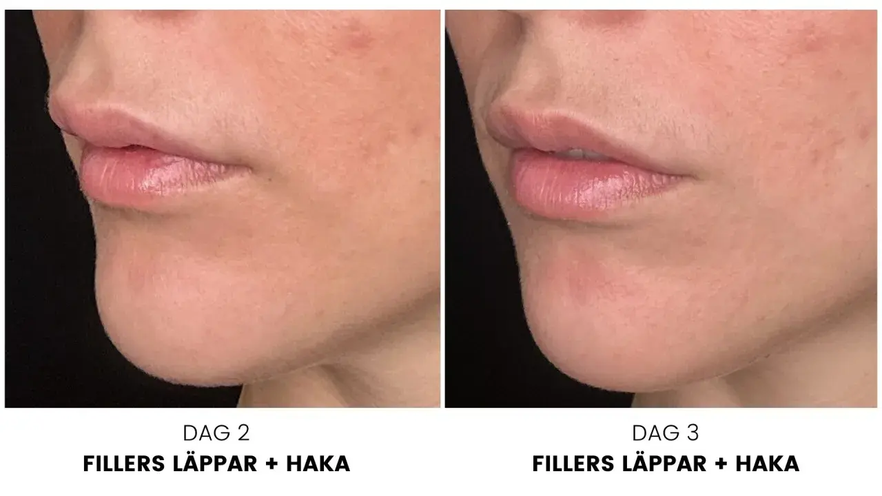 Före- och efterbilder av läppar och haka efter konsultation med fillers. Dag 2 och dag 3 visar en tydlig förbättring.