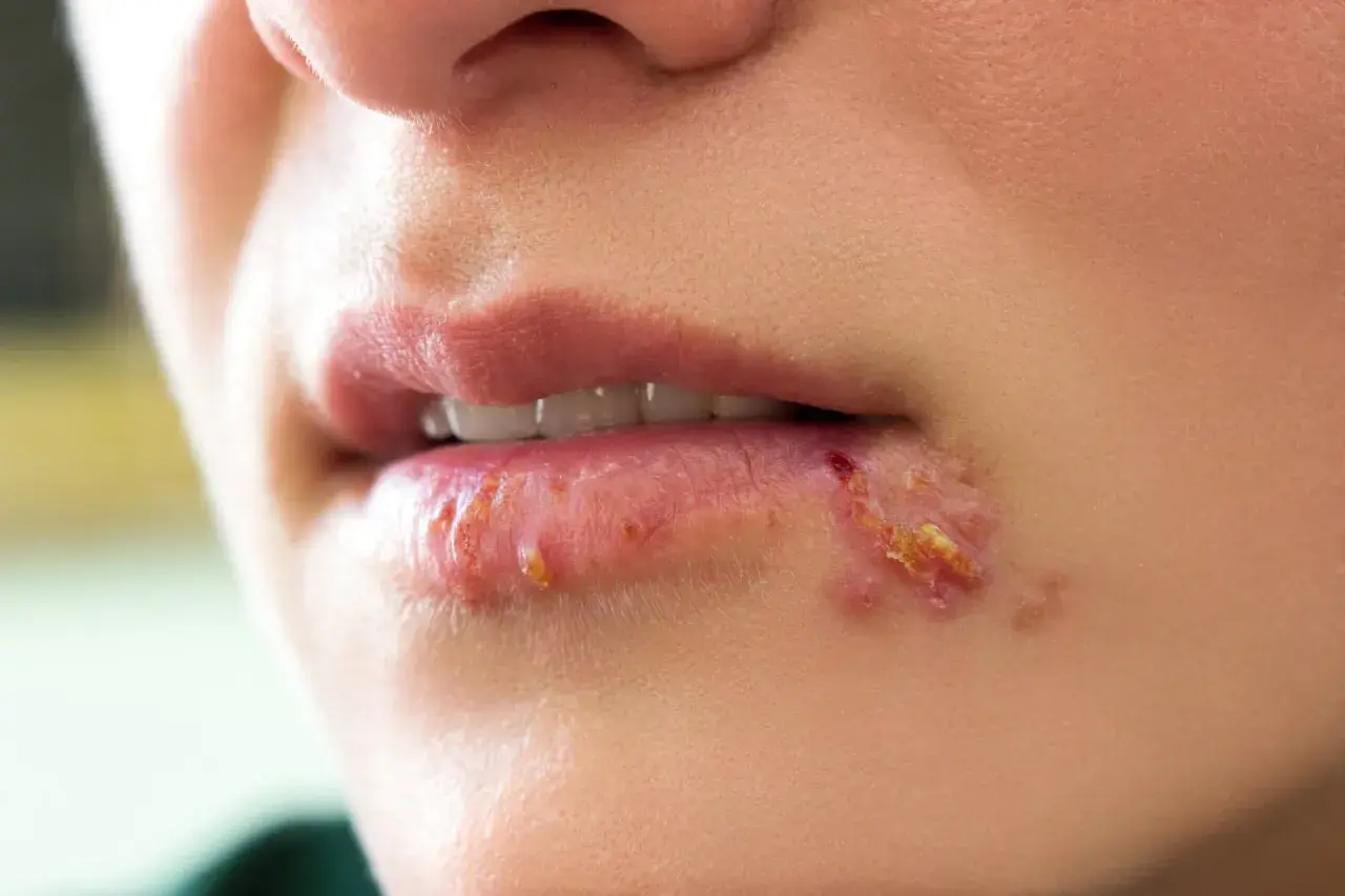 Gros plan sur une bouche avec une cloque sur la lèvre inférieure, montrant des lésions rouges et croûteuses.