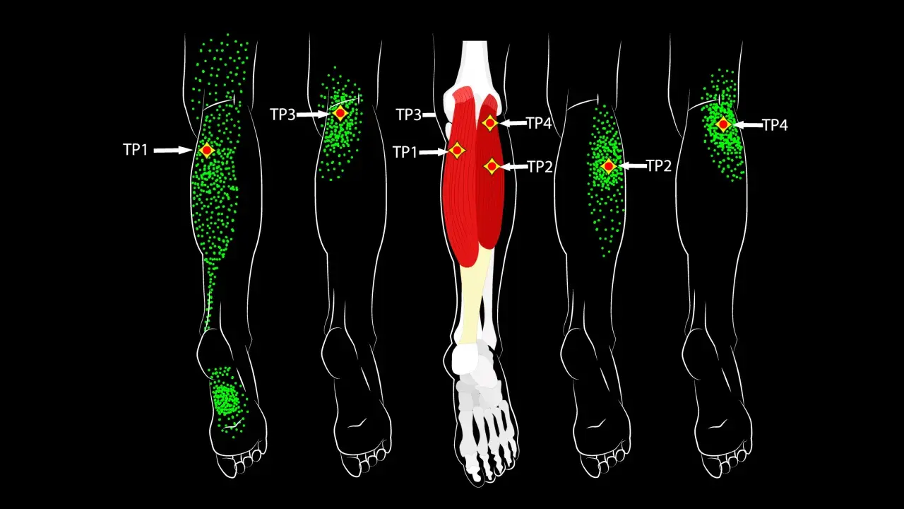 Schéma des jambes montrant des points verts indiquant des zones de douleur et des points rouges marquant la zone gâchette.