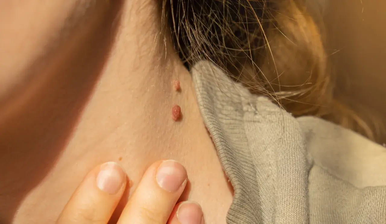 Gros plan sur le cou d'une personne montrant deux acrochordons, aussi appelés grains de beauté, près d'un col de vêtement.