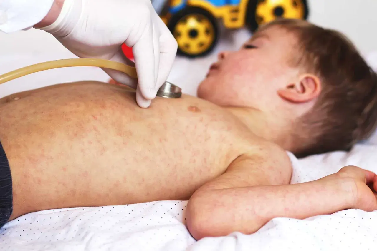 Läkare undersöker ett barn med utslag, möjligen biverkningar efter 5 månaders vaccin.