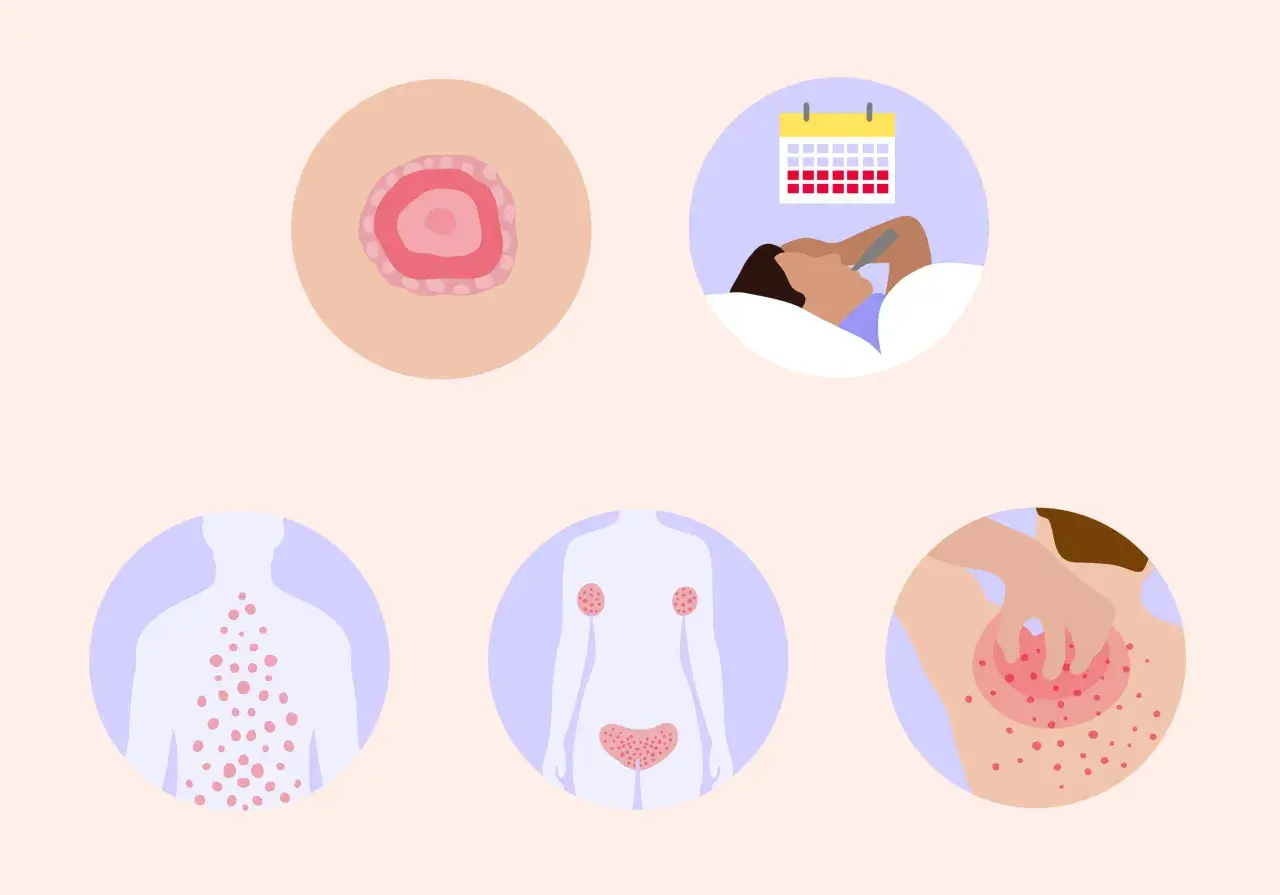 Immagine illustra la pitiriasi rosea di Gibert, con un medaglione iniziale, eruzione cutanea diffusa, e un'icona che suggerisce stress e malessere.