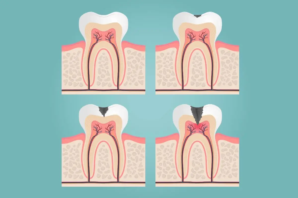 Ilustración de un diente con caries progresiva, mostrando la necesidad de un empaste o endodoncia para salvarlo.