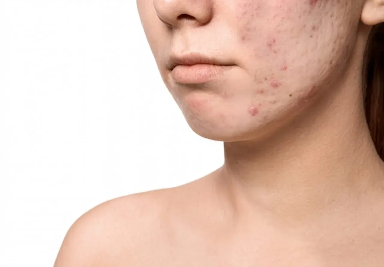 Primo piano di un volto con pelle congestionata e acne. Imperfezioni visibili sul mento e sulla guancia.