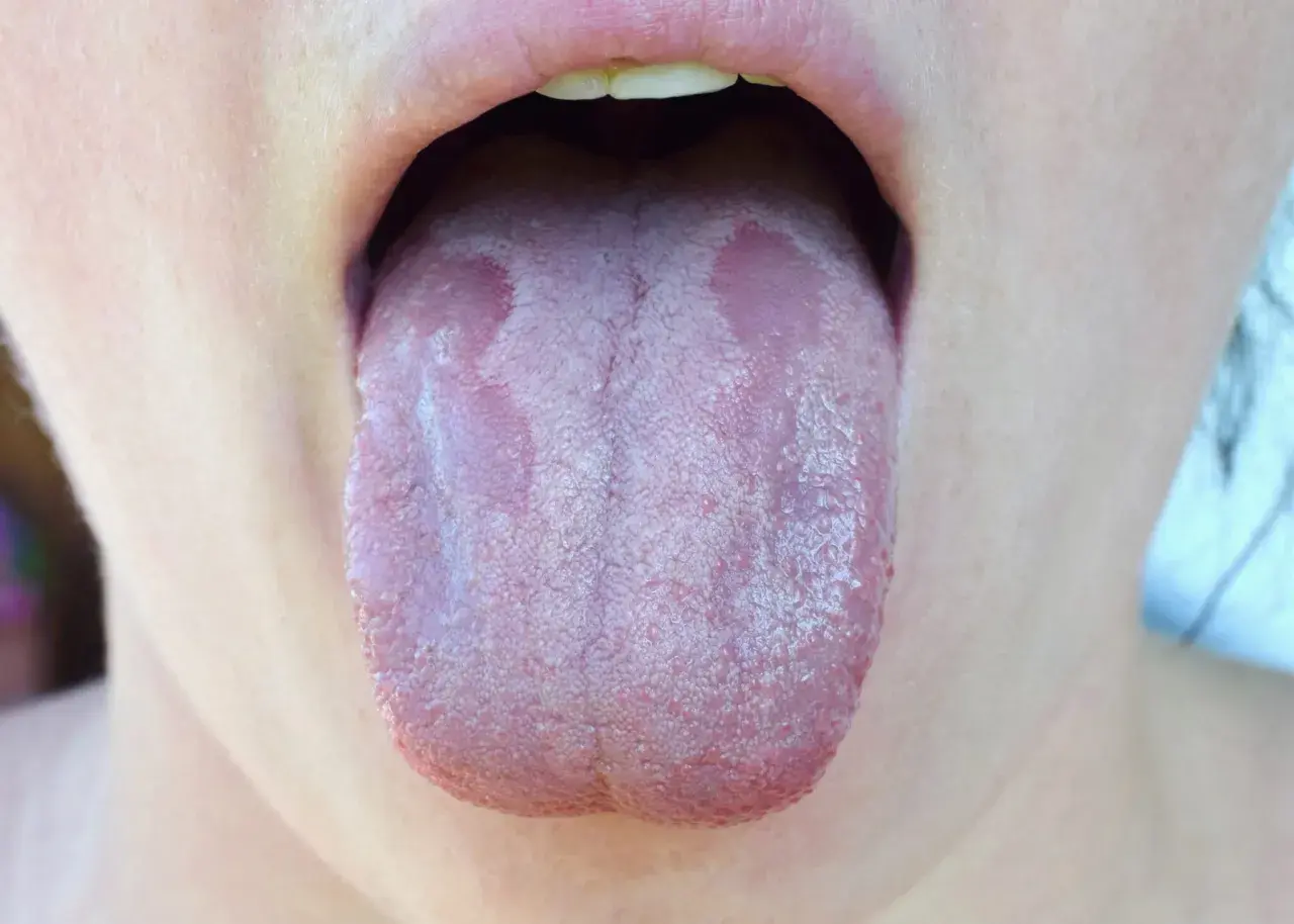 Lingua con placche biancastre, suggestive di candida lingua.