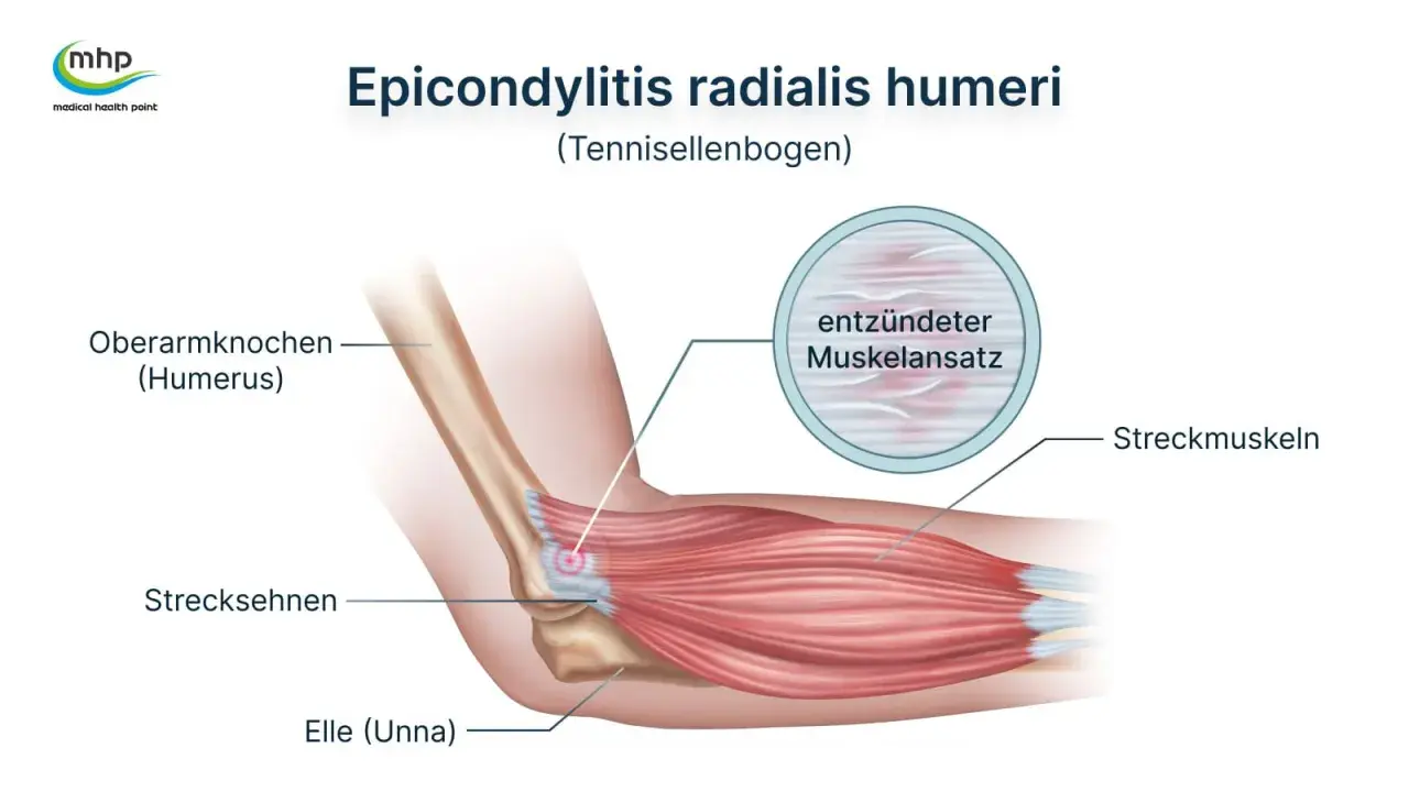Illustration zeigt den Tennisellenbogen (Epicondylitis radialis humeri) mit entzündetem Muskelansatz. Darf man mit Tennisarm arbeiten? Ja, oft mit Anpassungen.