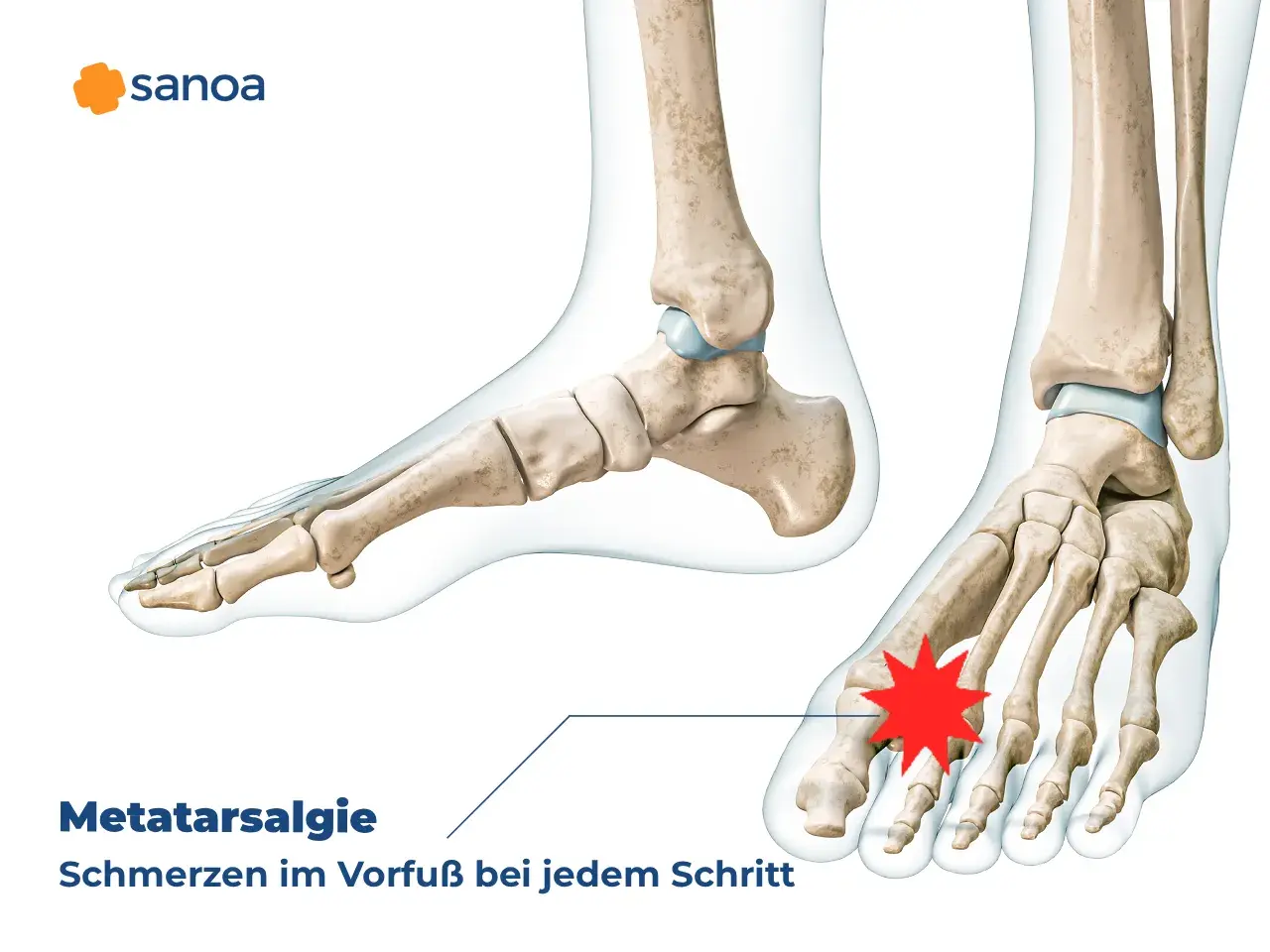 Metatarsalgie: Schmerzen im Vorfuß bei jedem Schritt. Anatomische Darstellung des Fußskeletts mit Hervorhebung des schmerzenden Bereichs.