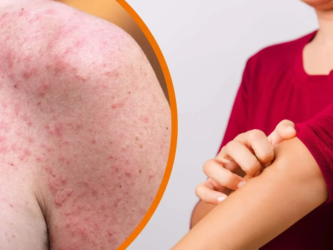 Rote, entzündete Haut mit vielen kleinen Pickelchen am Arm, die jucken. Hitzepickel am Arm sind unangenehm.