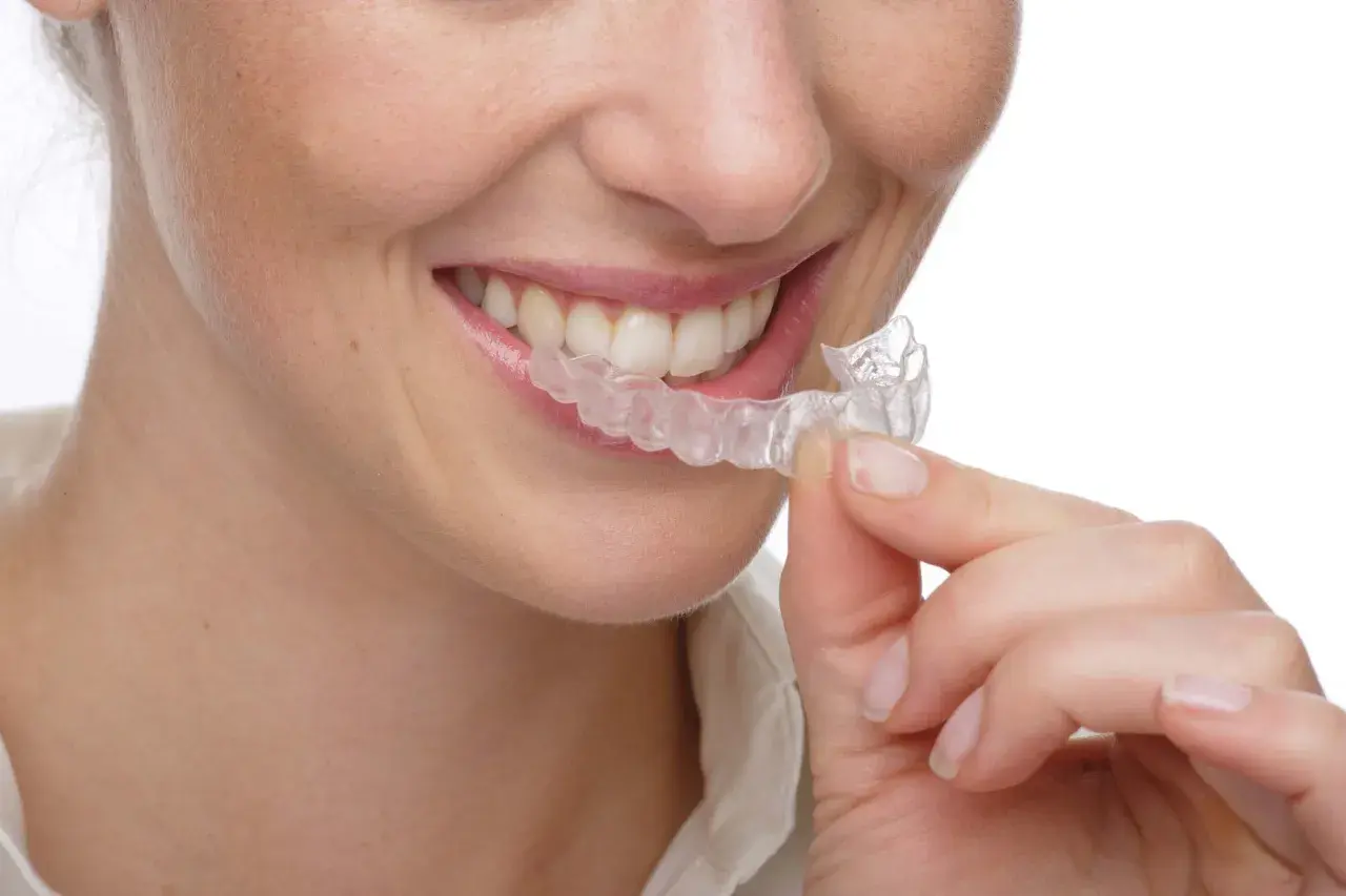 Sonrisa de mujer con férulas transparentes. A pesar de que los **invisalign duelen** un poco al principio, la sonrisa vale la pena.