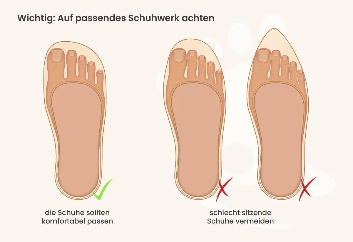 Passende Schuhe sind wichtig, um Druckstellen am Zeh zu vermeiden. Links ein Fuß im gut sitzenden Schuh, rechts Füße in zu engen Schuhen.