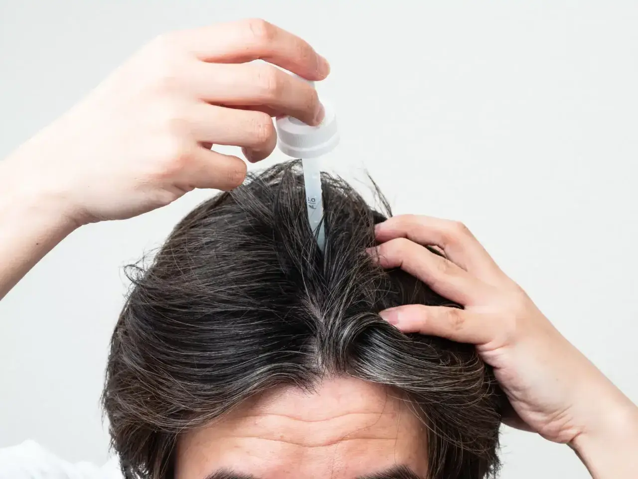 Persona aplica un gotero en su cuero cabelludo, buscando alternativas al minoxidil para el crecimiento capilar.