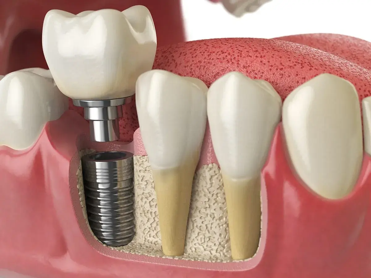 Impianto dentale che sostituisce un dente mancante, soluzione per l'edentulia.