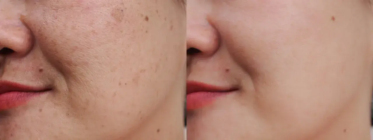 Comparación de piel: antes con manchas y poros visibles, después con piel lisa y uniforme.