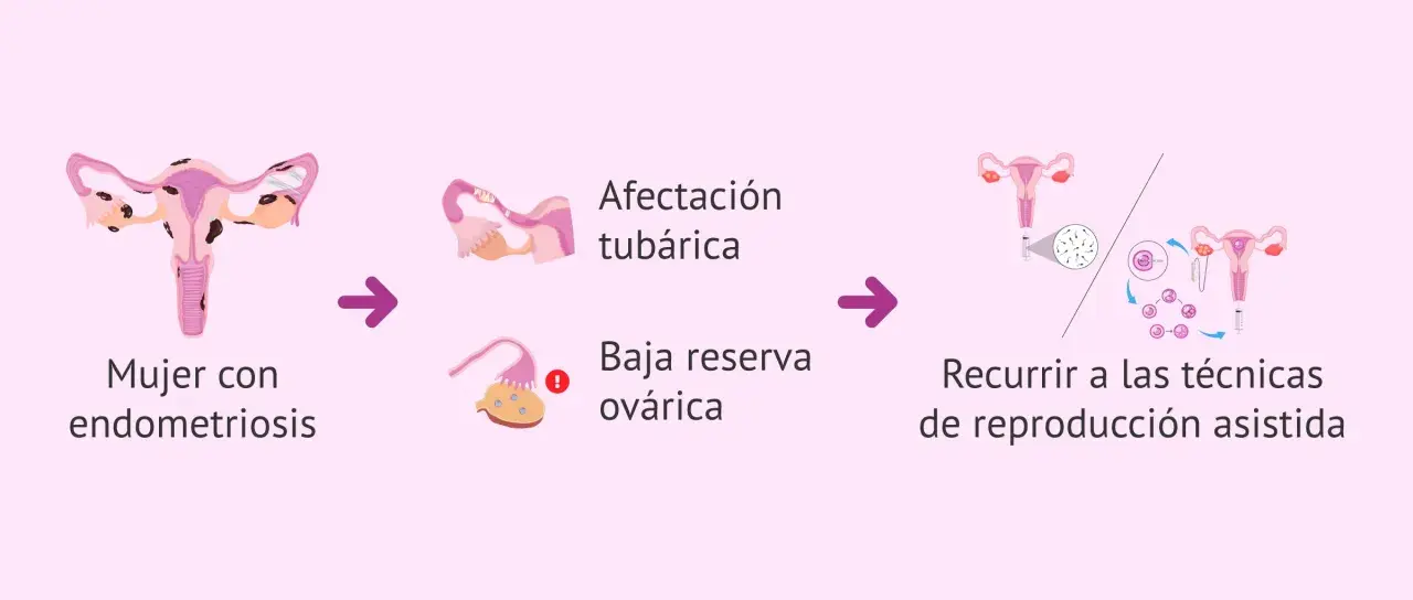 Ilustración muestra cómo la endometriosis puede afectar las trompas y ovarios, llevando a la necesidad de técnicas de reproducción asistida para el embarazo.