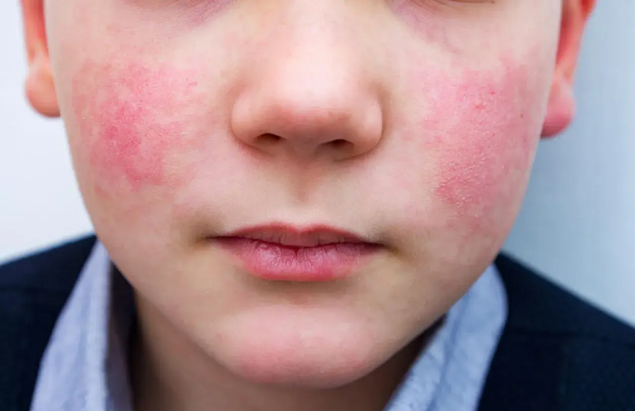 Primo piano del viso di un bambino con guance rosse e calde, forse per il freddo o un'allergia. La pelle appare leggermente screpolata.