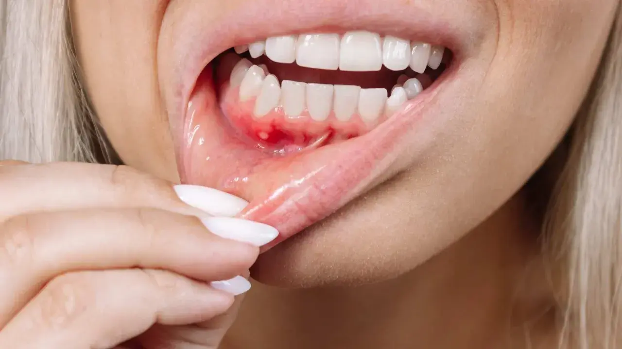 Detalle de una boca con úlceras y enrojecimiento, mostrando posibles causas de boca irritada por dentro.
