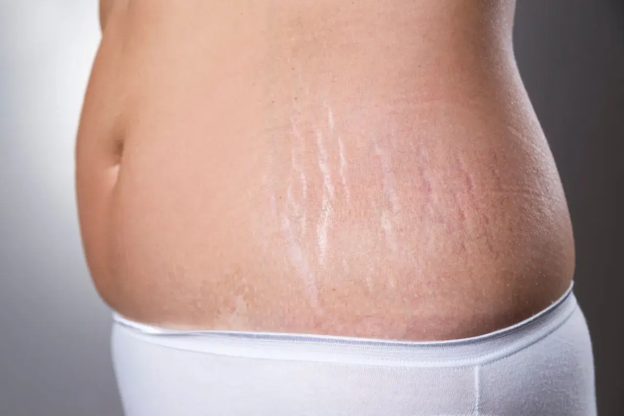Bauch einer Frau mit Dehnungsstreifen, ein Zeichen der zweiten Schwangerschaft.