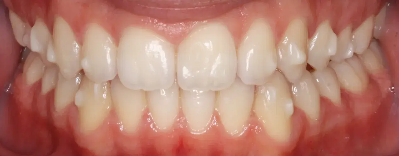 Dientes alineados y sanos, resultado de un tratamiento de ortodoncia invisible, **invisalign sin ataches**.