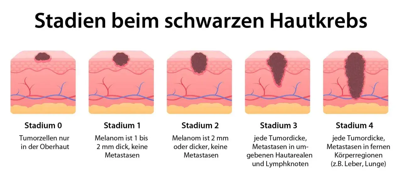 Illustration zeigt Stadien von schwarzem Hautkrebs. Symptome reichen von frühen Tumoren in der Oberhaut bis zu Metastasen in entfernten Körperregionen.