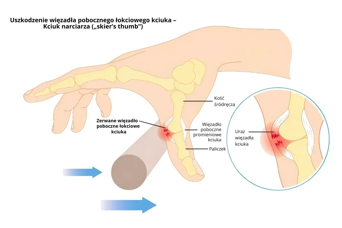 Ilustracja anatomiczna kciuka z zaznaczonym zerwanym więzadłem pobocznym łokciowym.