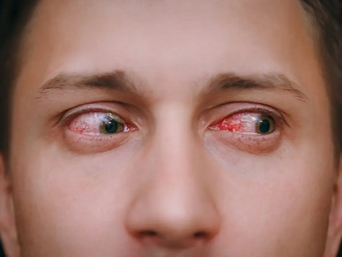 Ojos rojos e irritados, señal de que la conjuntivitis es contagiosa.