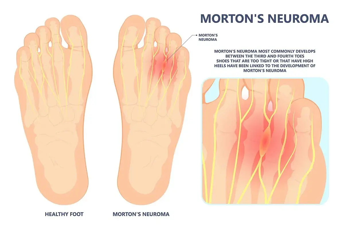 Illustration zeigt gesunde Fußsohle und Morton-Neurom. Selbsthilfe bei Morton-Neurom durch passende Schuhe ist wichtig.