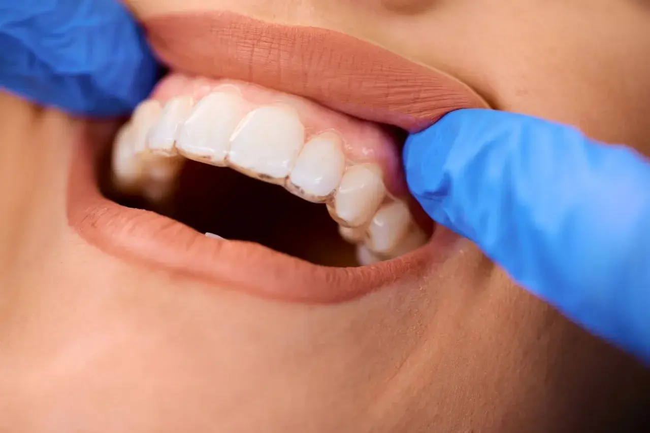 Dentyści w niebieskich rękawiczkach poprawiają przezroczysty aparat ortodontyczny, korygując zgryz otwarty.