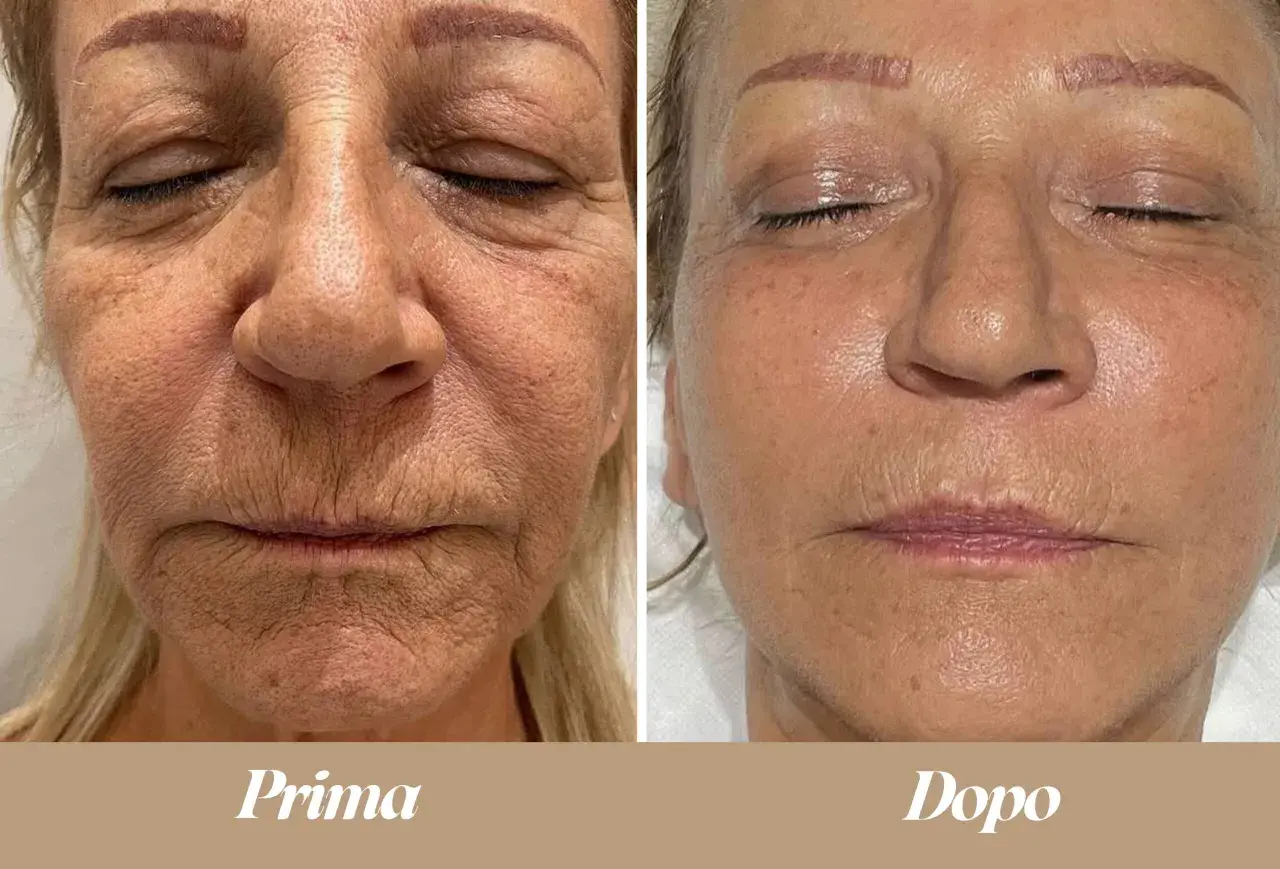 Confronto prima/dopo: il terzo superiore del viso mostra una pelle più liscia e luminosa dopo il trattamento.