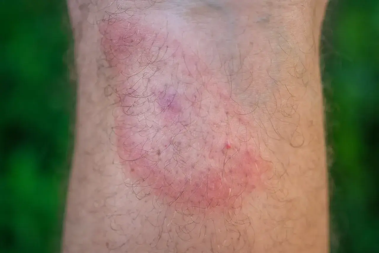 Rote, juckende Stelle am Bein nach einem Zeckenbiss. Wann zum Arzt? Informieren Sie sich über Symptome und Behandlung.