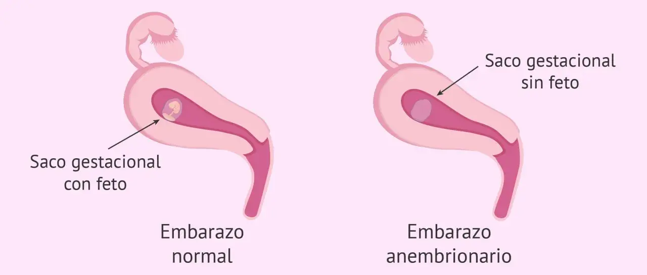 Ilustración comparativa de un embarazo normal con saco gestacional y feto, y un embarazo anembrionario con saco gestacional sin feto. Experiencias de embarazo anembrionario.