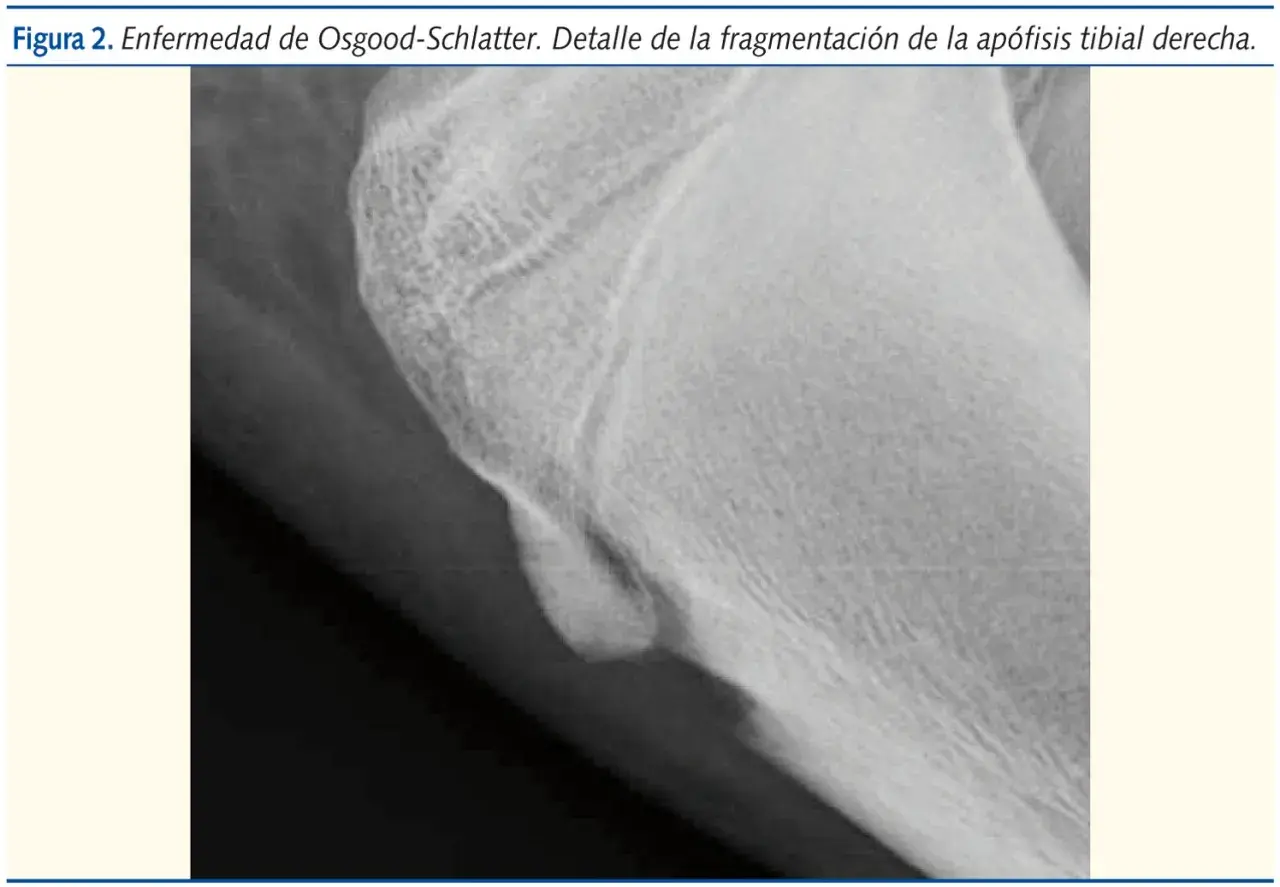 Radiografía de rodilla que muestra fragmentación de la apófisis tibial derecha, indicativo de Osgood-Schlatter.