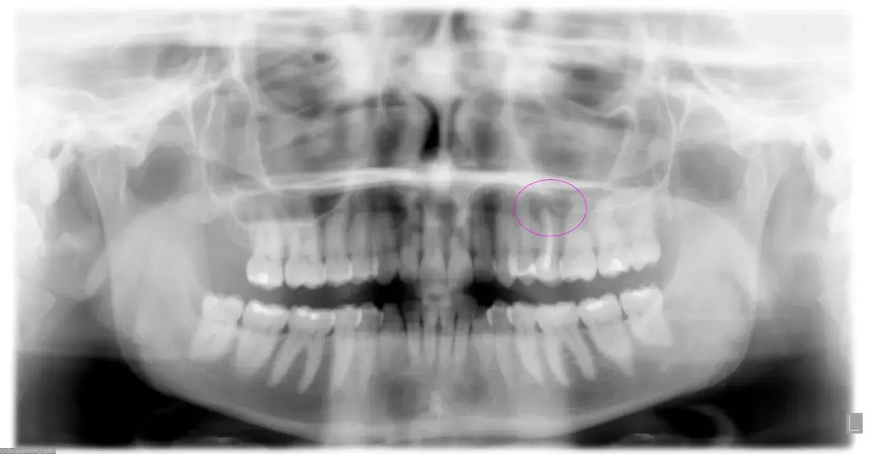 Radiografía panorámica dental que muestra la necesidad de una exodoncia quirúrgica de un diente superior, resaltado en círculo.