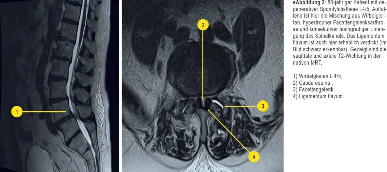 MRT-Aufnahmen der Lendenwirbelsäule zeigen eine Spondylolisthese L4/5, die auf Osteochondrose LWS hindeutet. Verdicktes Ligamentum flavum verengt den Spinalkanal.