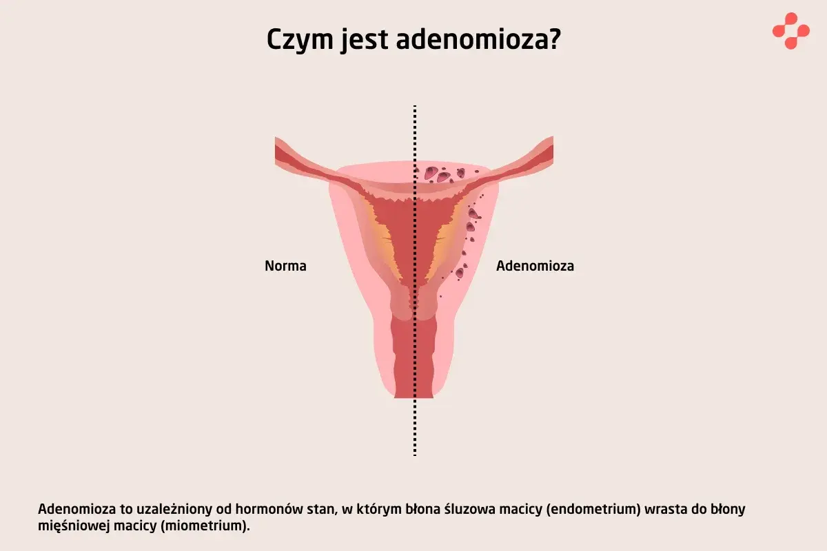 Ilustracja porównuje zdrową macicę z macicą z **adenomiozą**, gdzie tkanka endometrium wrasta w mięsień macicy.