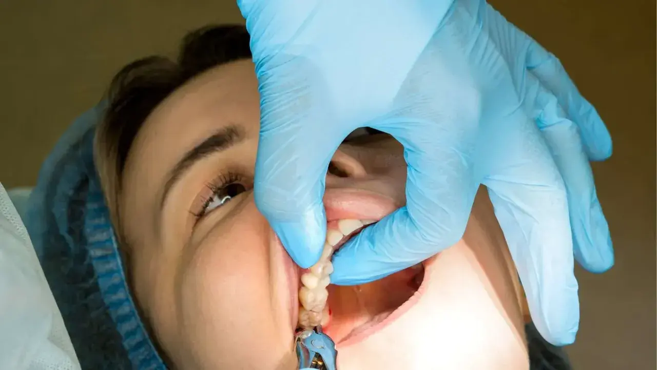 Un dentista usa guantes azules para extraer dientes. Se ven los puntos reabsorbibles en la boca de la paciente.