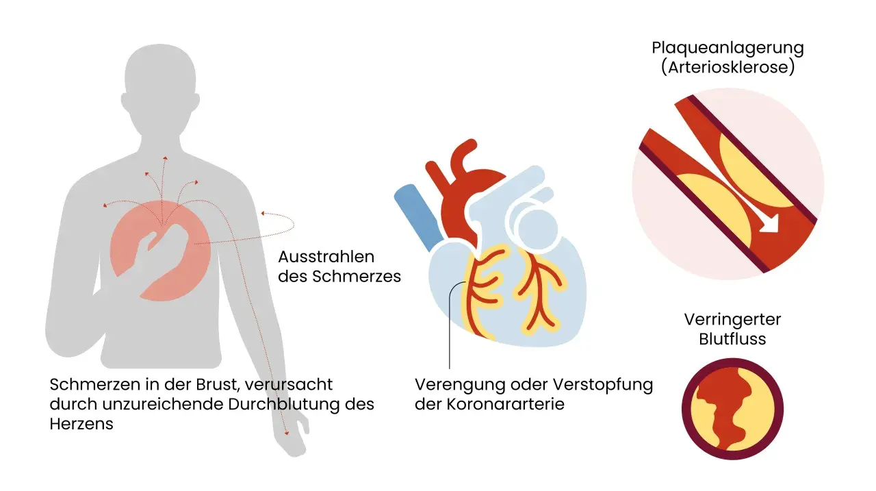 Brustschmerzen, die in Arme ausstrahlen, sind ein Symptom von Angina Pectoris, verursacht durch verengte Koronararterien und verringerten Blutfluss zum Herzen.