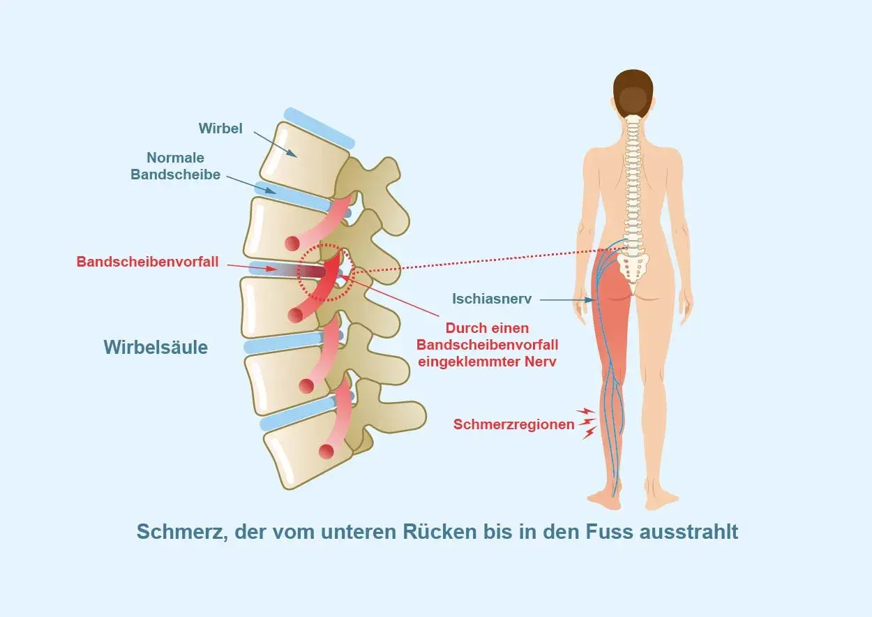 Bandscheibenvorfall klemmt Ischiasnerv ein, verursacht Schmerz vom Rücken bis zum Fuß. Was hilft sofort bei Ischias?