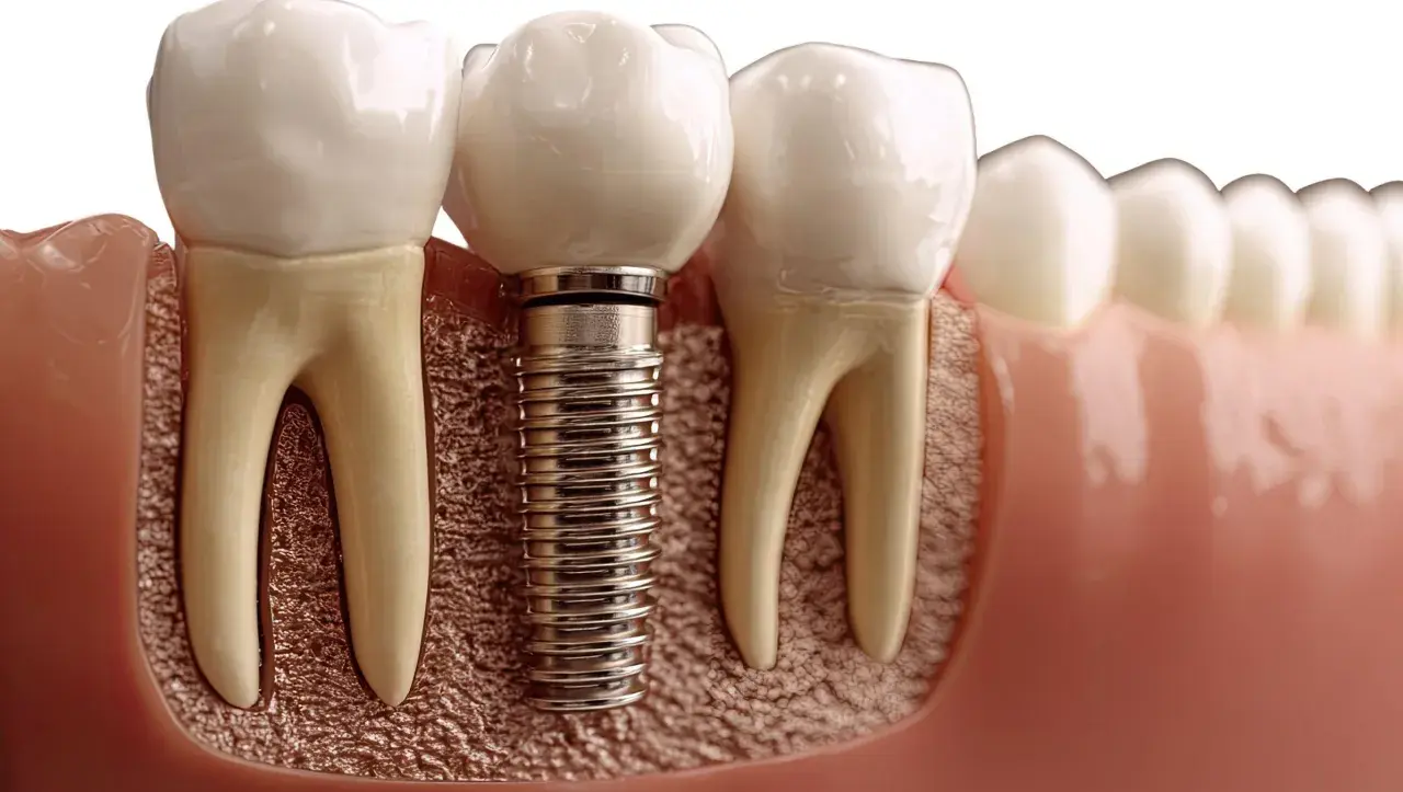 Dettaglio di un impianto dentale in titanio, parte di un processo di implantologia a carico immediato, che sostituisce una radice dentale.