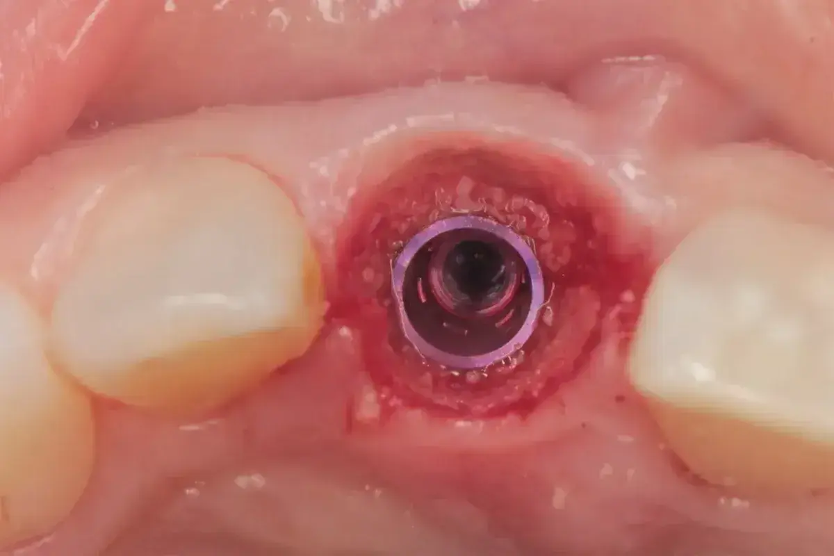 Implant dentystyczny w miejscu po wyrwaniu zęba. Po zabiegu może wystąpić gorączka po wyrwaniu zęba, ale implantacja jest bezpieczna.