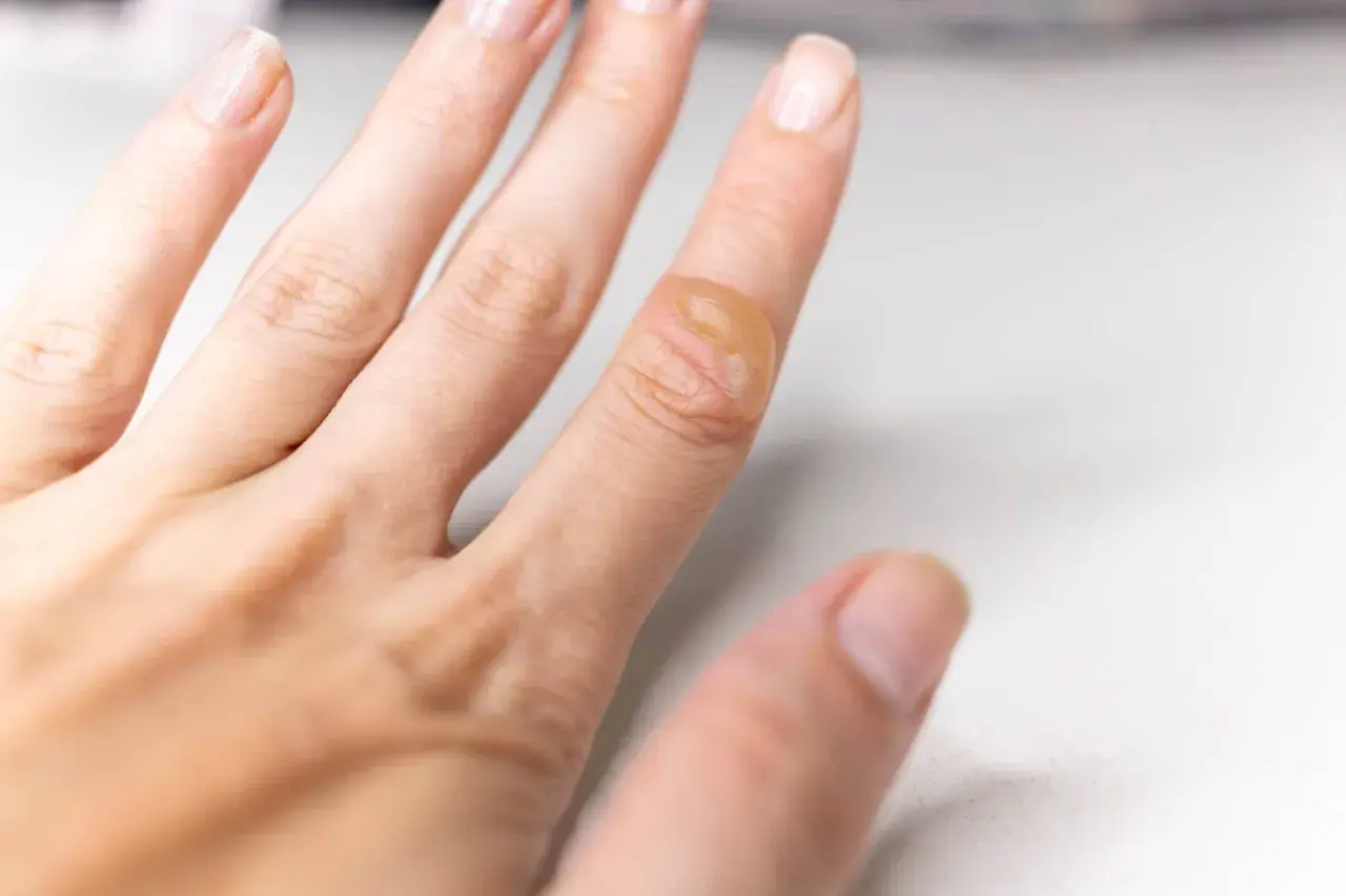 Gros plan sur une cloque de brûlure sur un doigt, suggérant des méthodes pour comment soigner une cloque de brûlure naturellement.