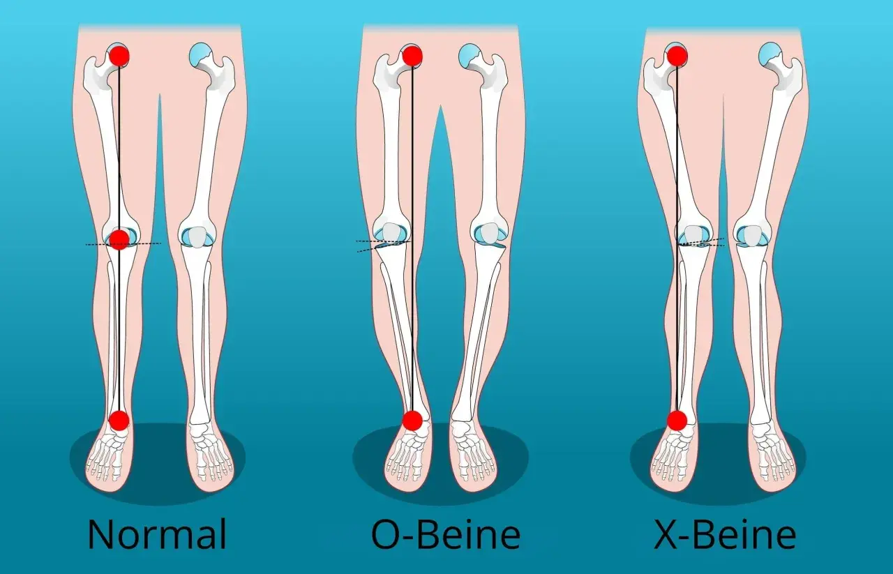 Vergleich von normalen Beinen, O-Beinen und X-Beinen. Die Darstellung zeigt die Knochenstruktur und die Ausrichtung der Gliedmaßen.