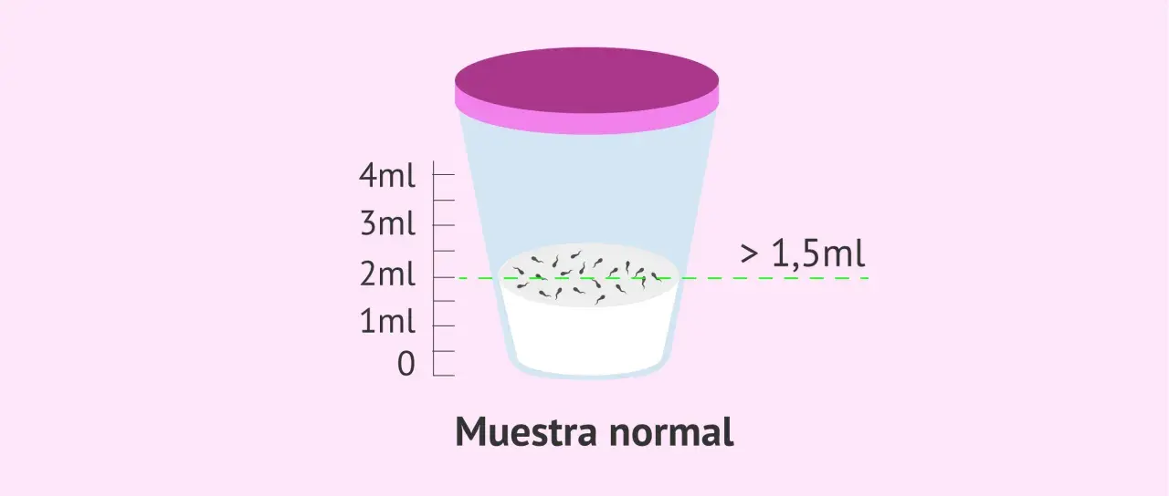 Recipiente con muestra de semen, indicando que la cantidad normal de espermatozoides en una eyaculación es mayor a 1,5ml.