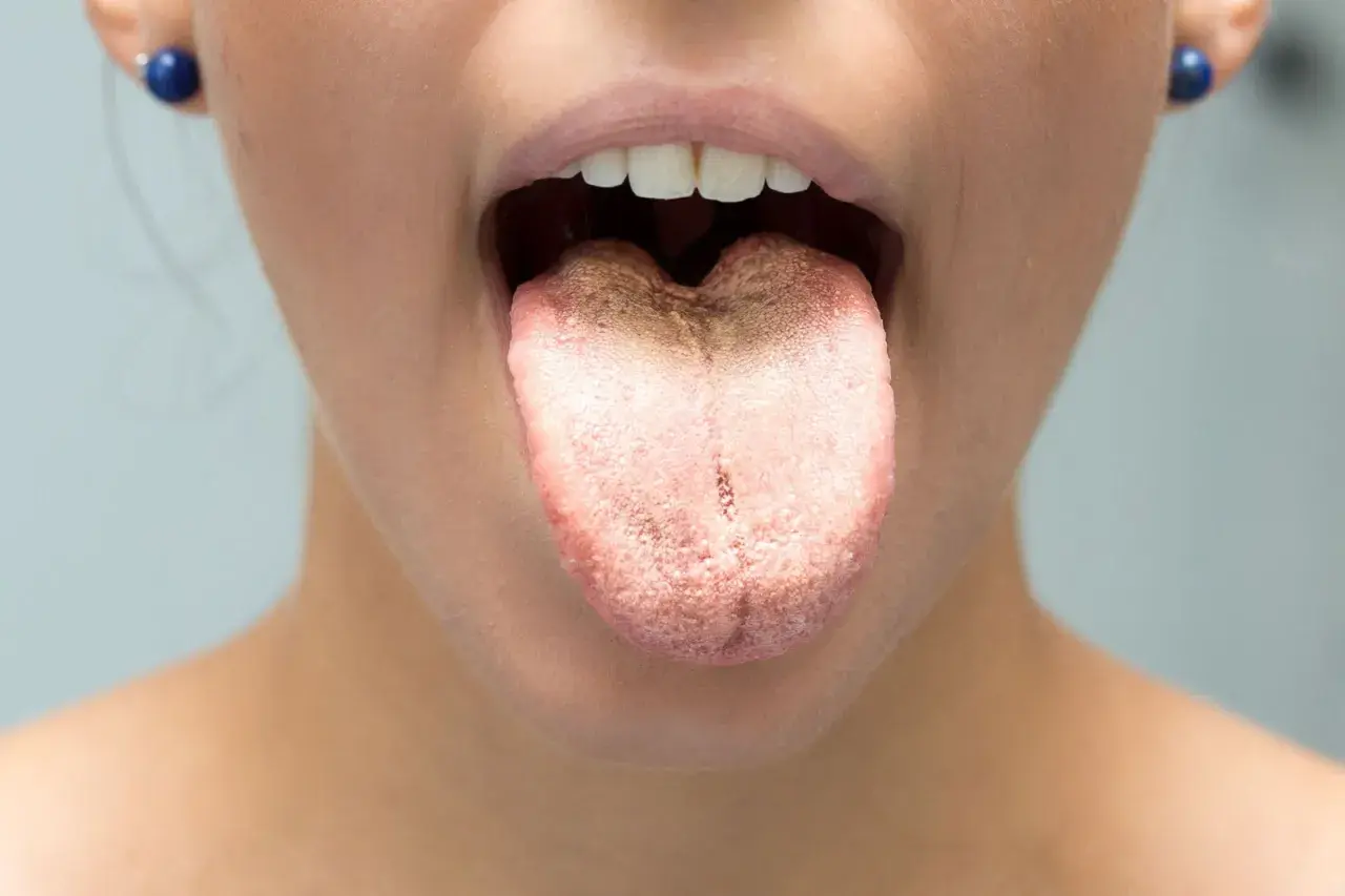 Lingua con patina biancastra, simile a un mughetto, che si estende sulla superficie.