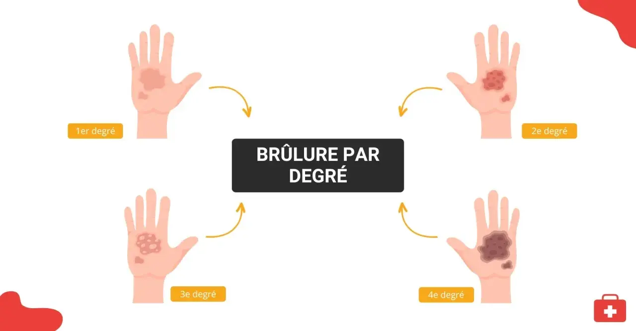 Illustration montrant l'évolution des brûlures de 1er degré à 4e degré sur une main. Le traitement d'une brûlure premier degré est le plus simple.